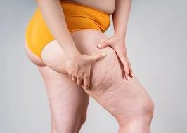 lipoedema.jpg
