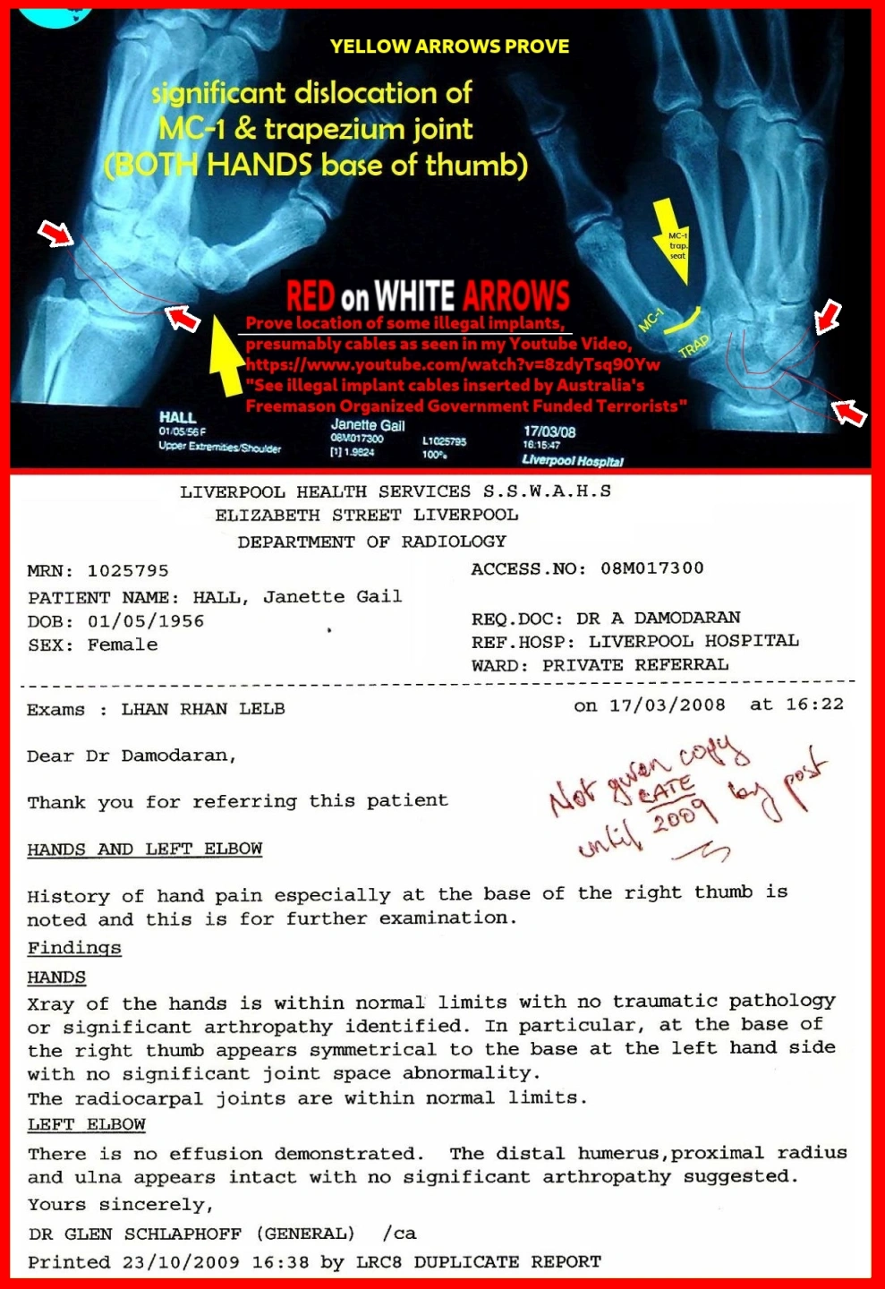THE HAND STORY 2025 both thumbs still dislocated, still assaulted with illegal implants - OUR MODERN GOVERNMENT STORY, if I'd known what absolute C U N T S they really are in Australia, I'd NEVER have brought children into this world to be their fodder.