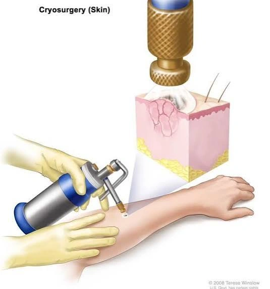 Cryotherapy.jpg