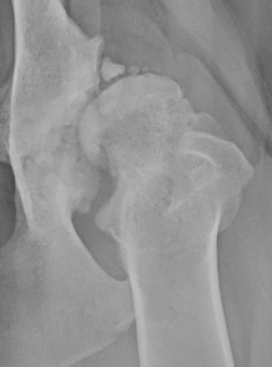 xray hip.png