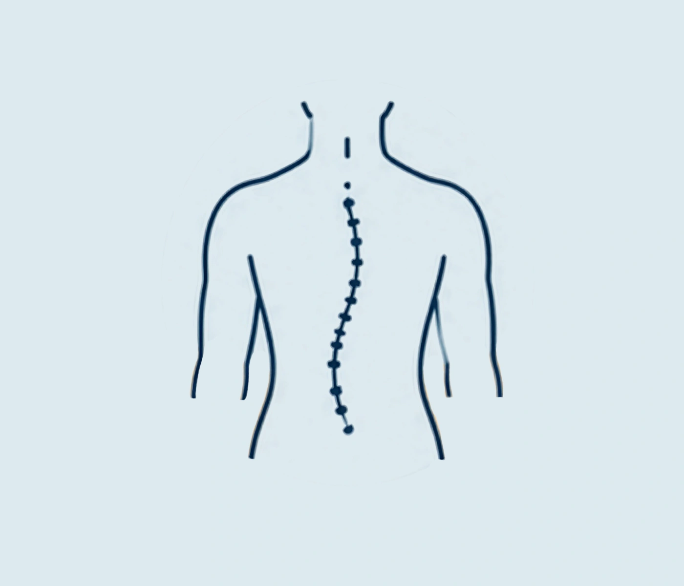 Scoliosis.png