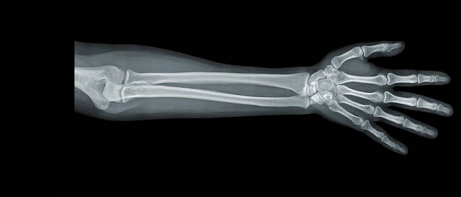 arm x-ray.png