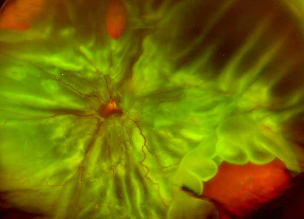 Retinal-Detachment-With-PVR.jpg