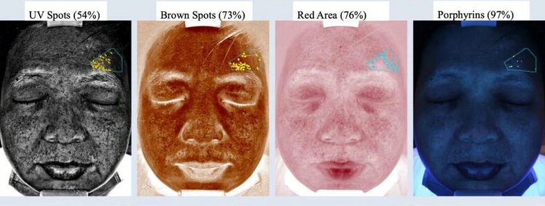 skin analysis machine.png
