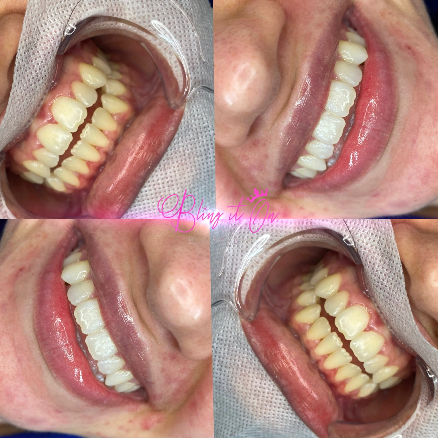 teeth whitening.JPEG