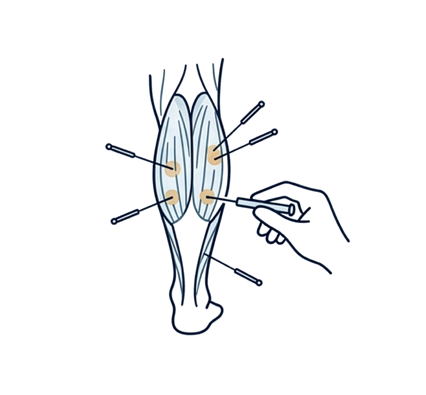 Dry Needling NoBG.png