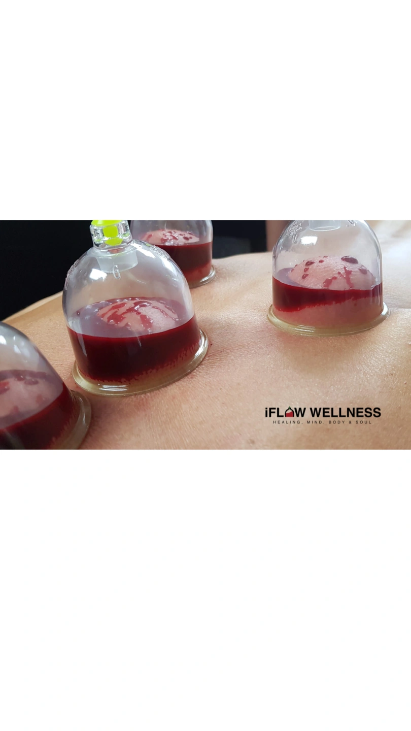 Hijama Wet Cupping ~ Moving Cupping~ Dry Cupping ~ Fire Cupping