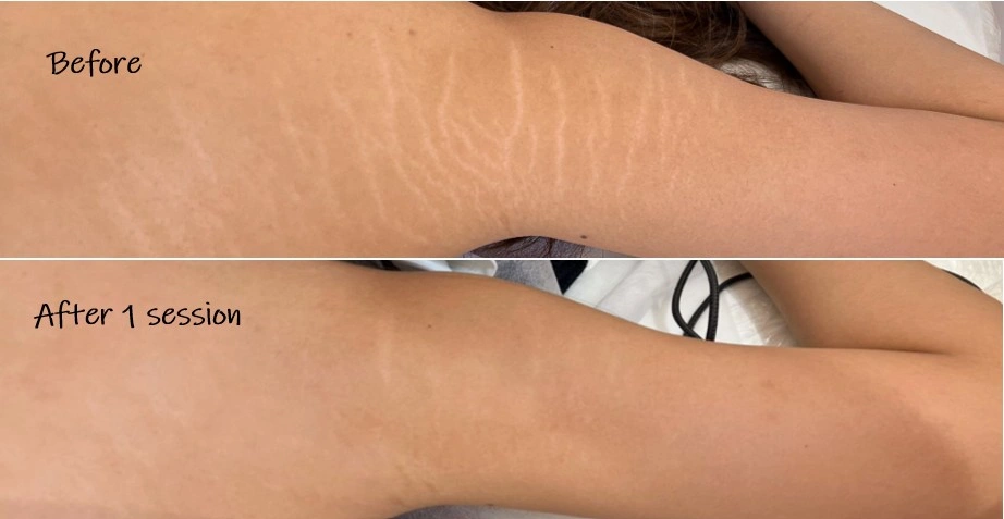 What is Paramedical and Skin Camoflague Tattooing?